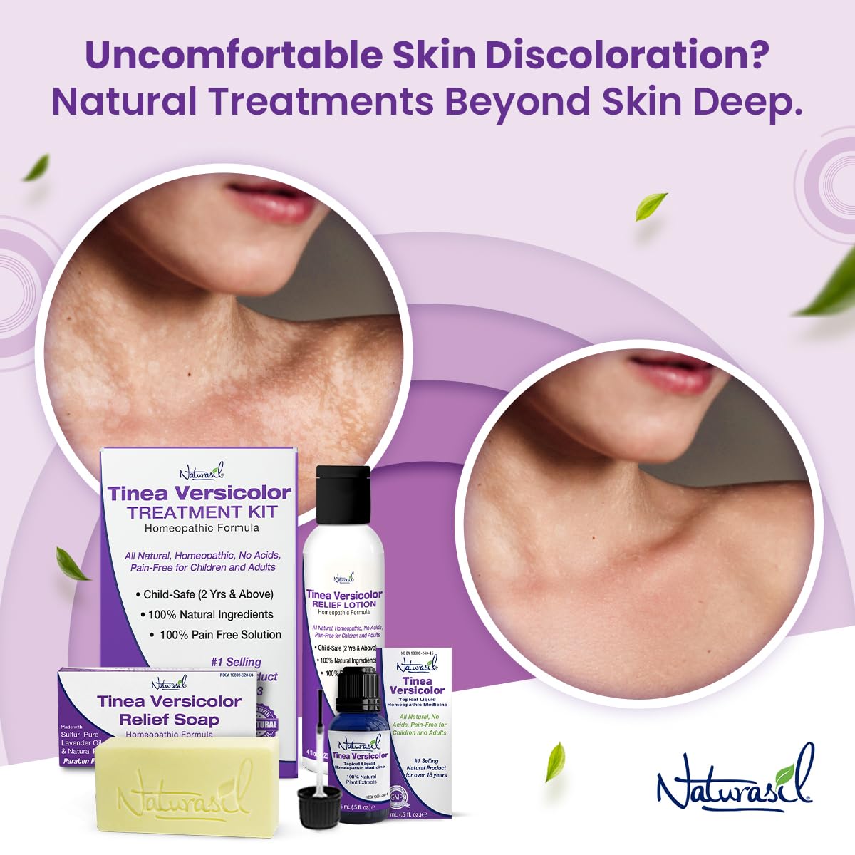 Bottle open reveals Naturasil lotion ready for use on affected areas