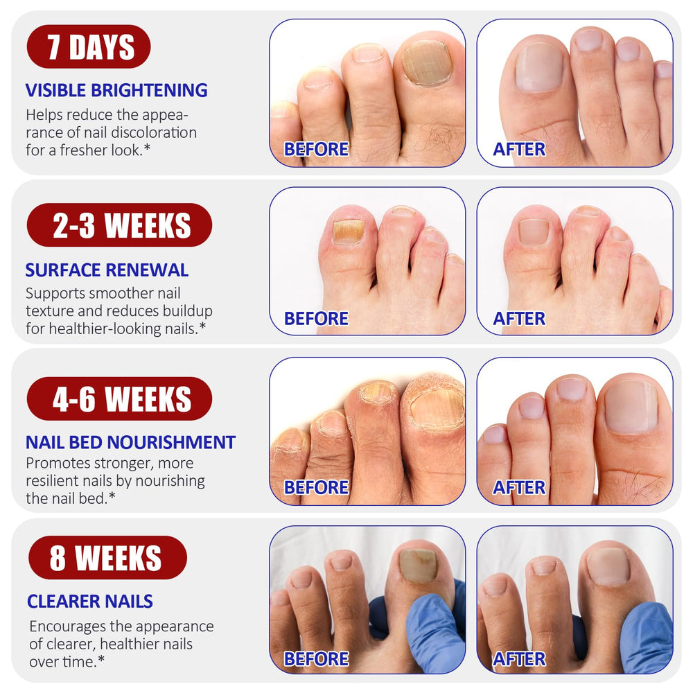 NBTREKTIE easy-apply nail patch for convenient nightly use.