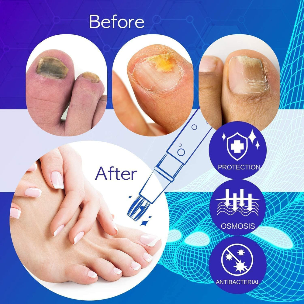 NEOMEN Nail Fungus Pen discolored nails showing improved color after use