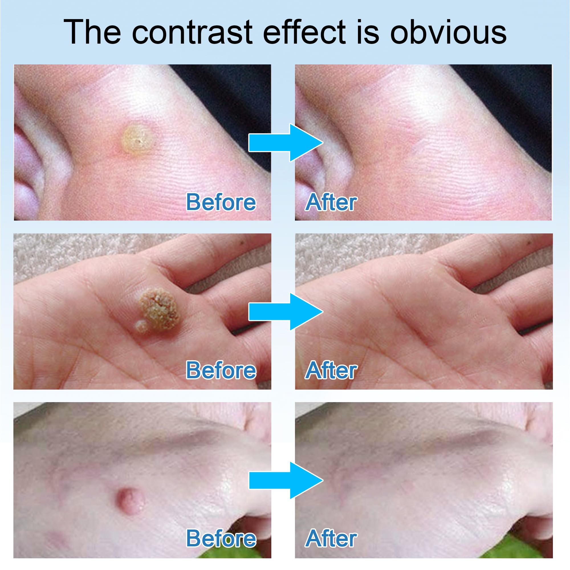 Nicetuff Wart Remover suitable for ages 4 and up on skin