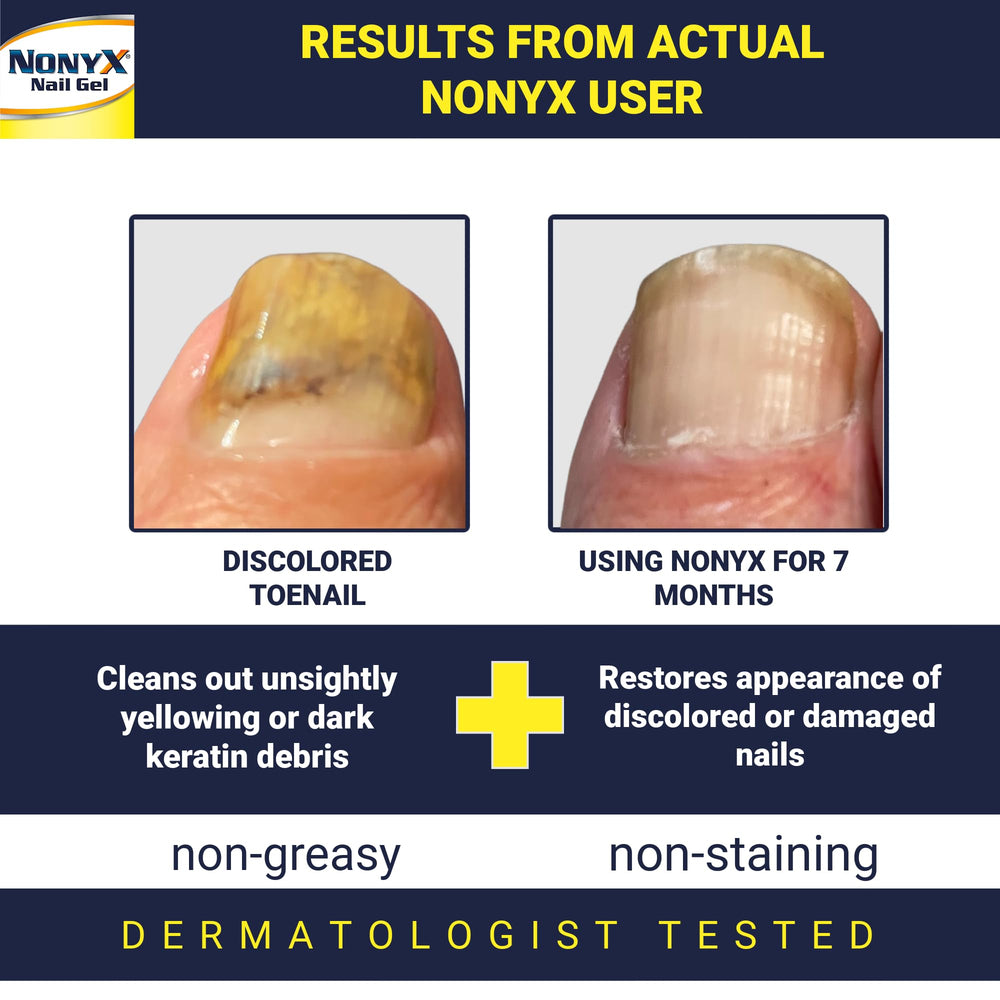 NONYX fungal nail clarifying gel applicator tip enables precise, mess-free use.