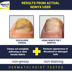 NONYX fungal nail clarifying gel applicator tip enables precise, mess-free use.