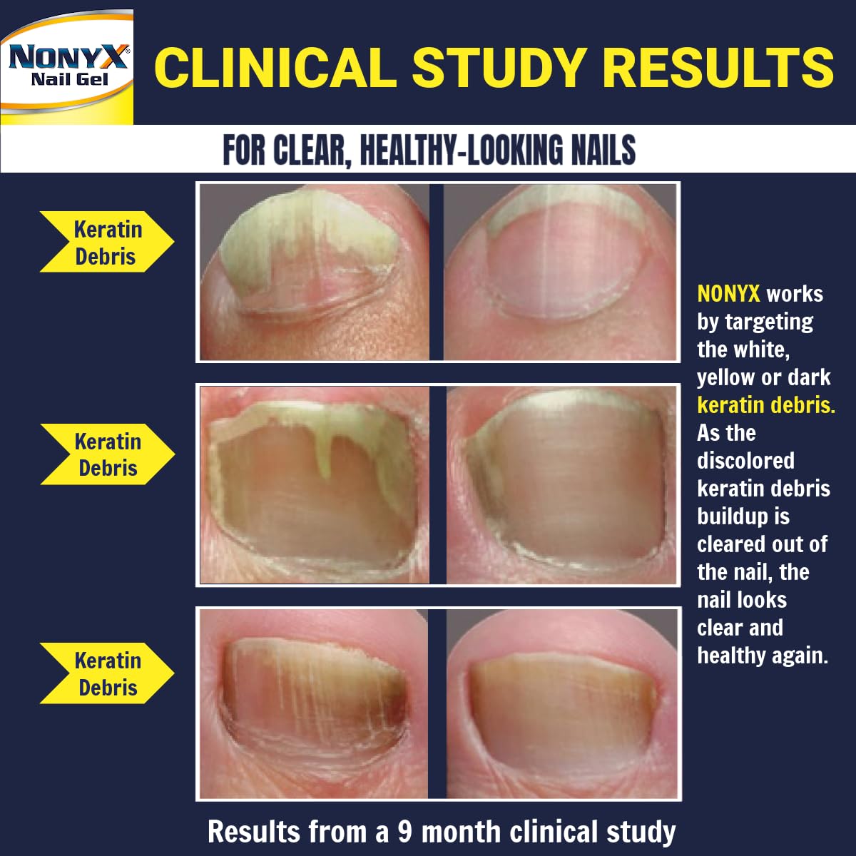 NONYX fungal nail clarifying gel drops show controlled dispensing for targeted care.