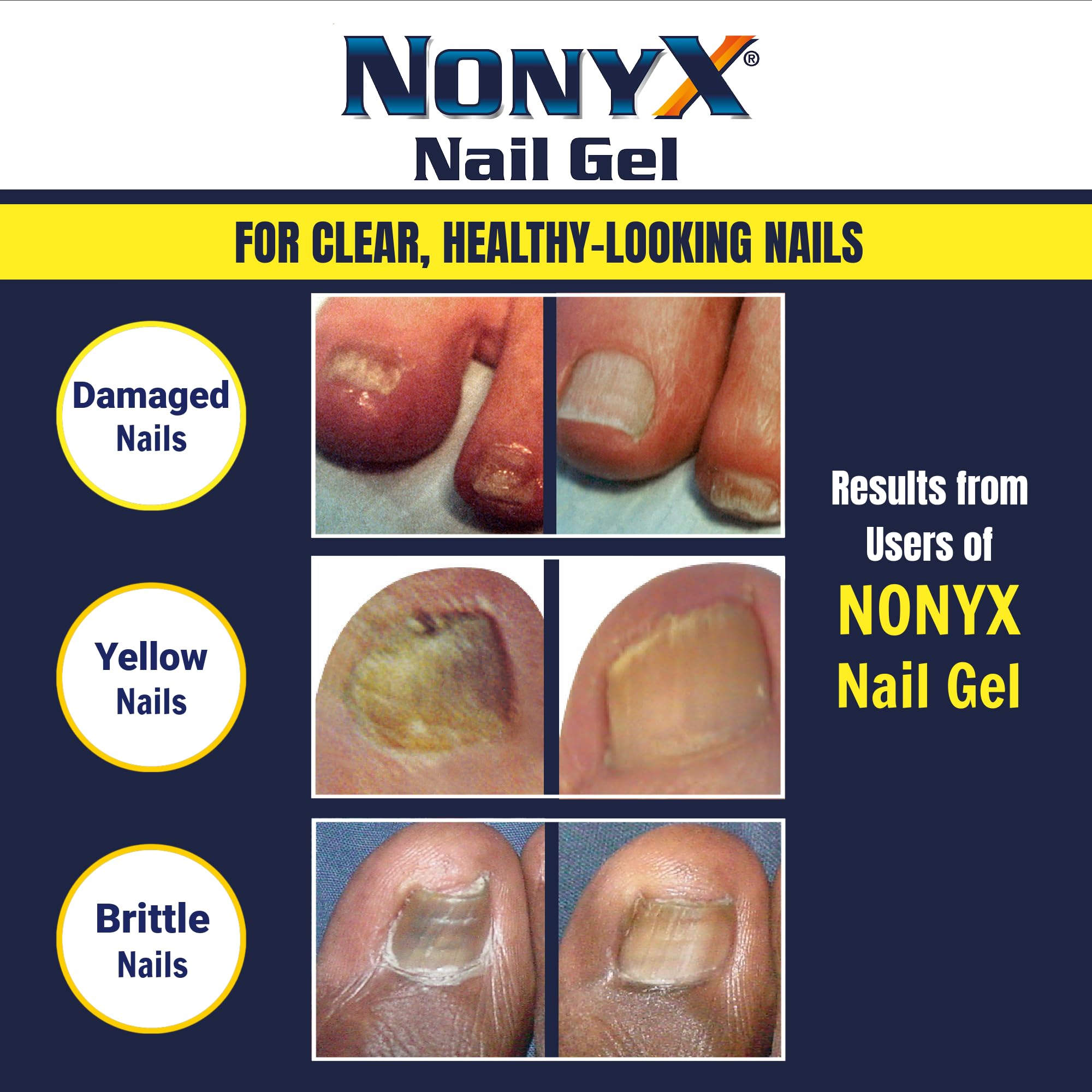 NONYX fungal nail clarifying gel dries clear for seamless polish wear.
