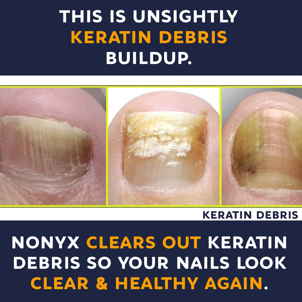 NONYX fungal nail clarifying gel made in USA for quality and accessibility.