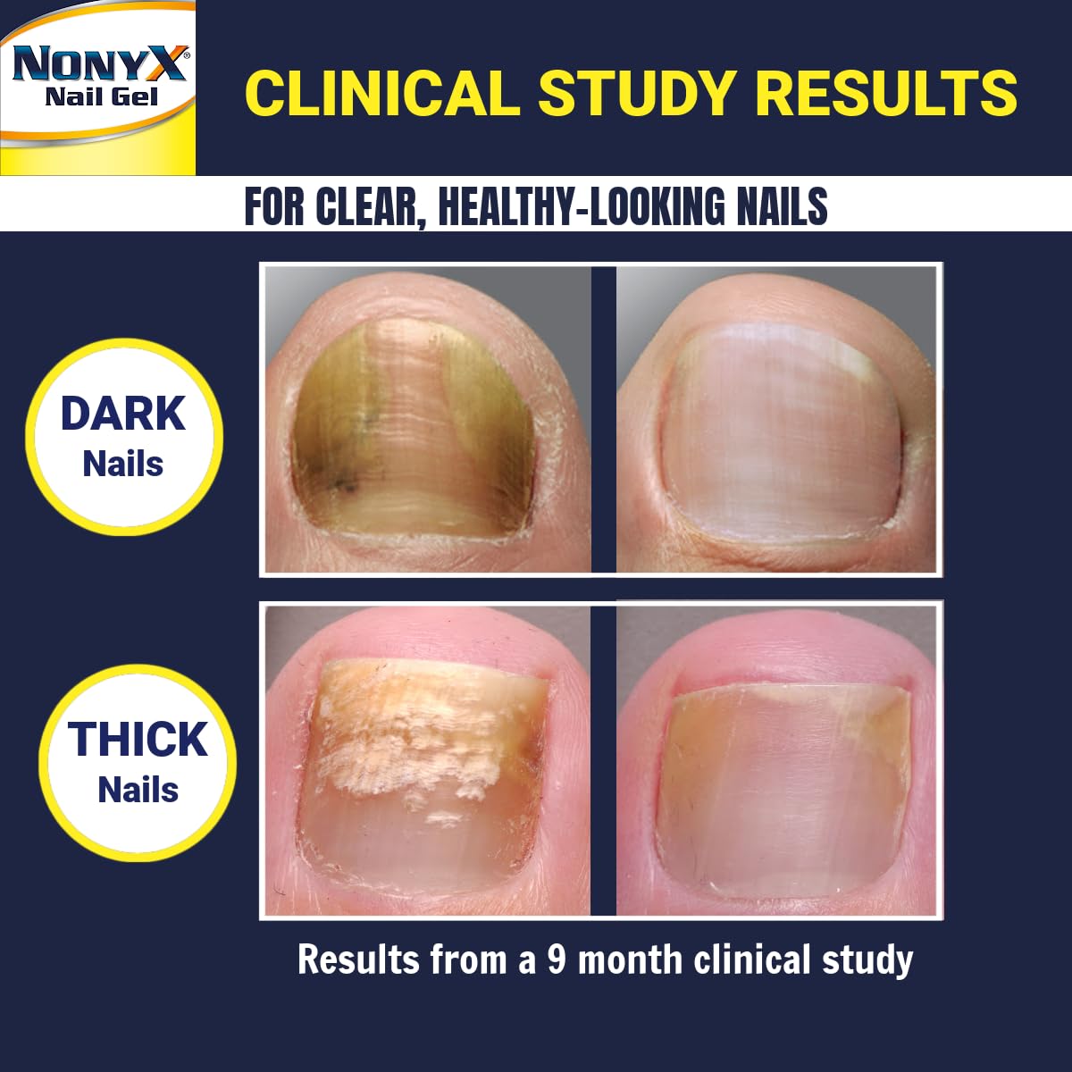 NONYX fungal nail clarifying gel packaging box provides clear product information on shelf.