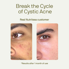 Nutriissa ACNEtane Pantothenic Acid visual emphasizes oil control potential