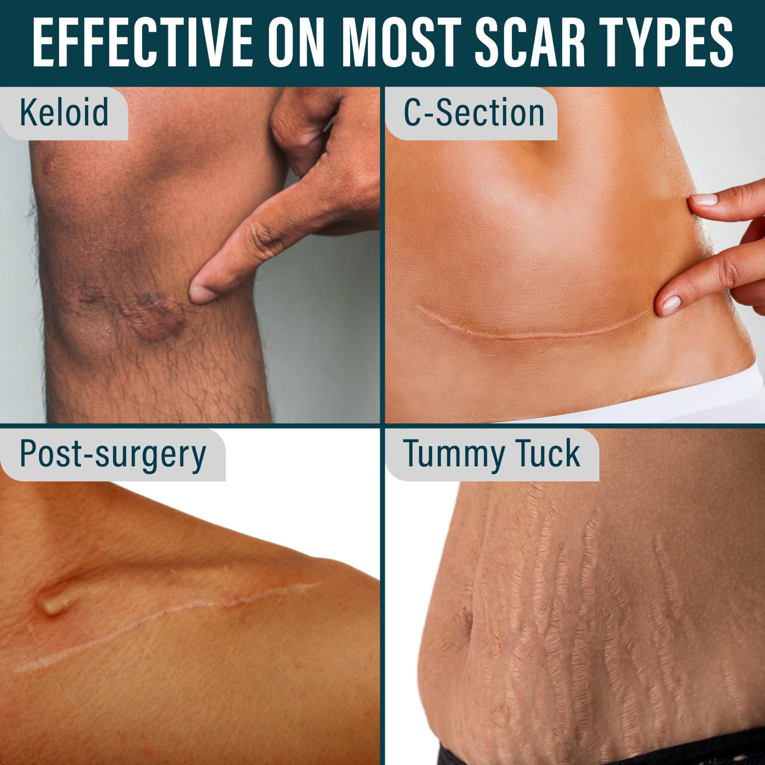 NUVADERMIS scar tape conforms for 24-hour wear on skin.
