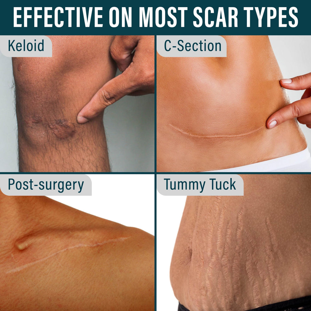 NUVADERMIS scar tape conforms for 24-hour wear on skin.