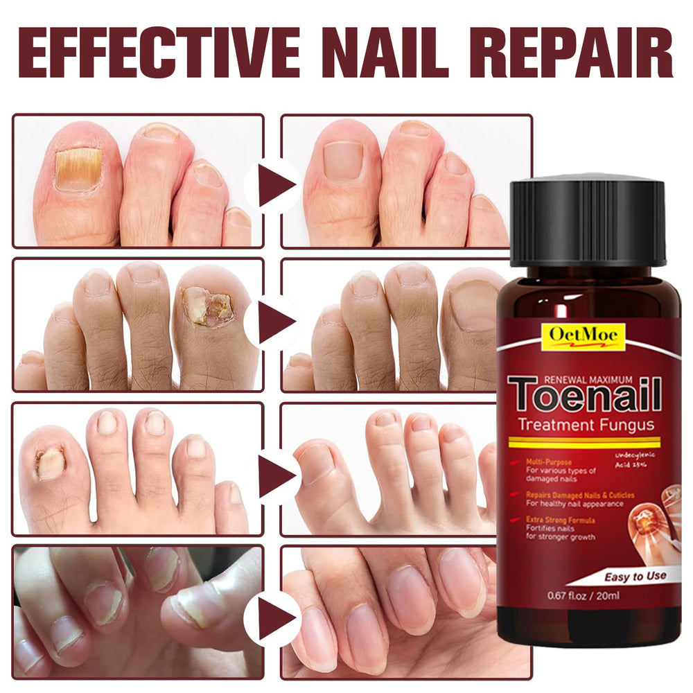OETMOE yellowing nails show visible improvement with daily use.