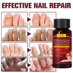 OETMOE yellowing nails show visible improvement with daily use.