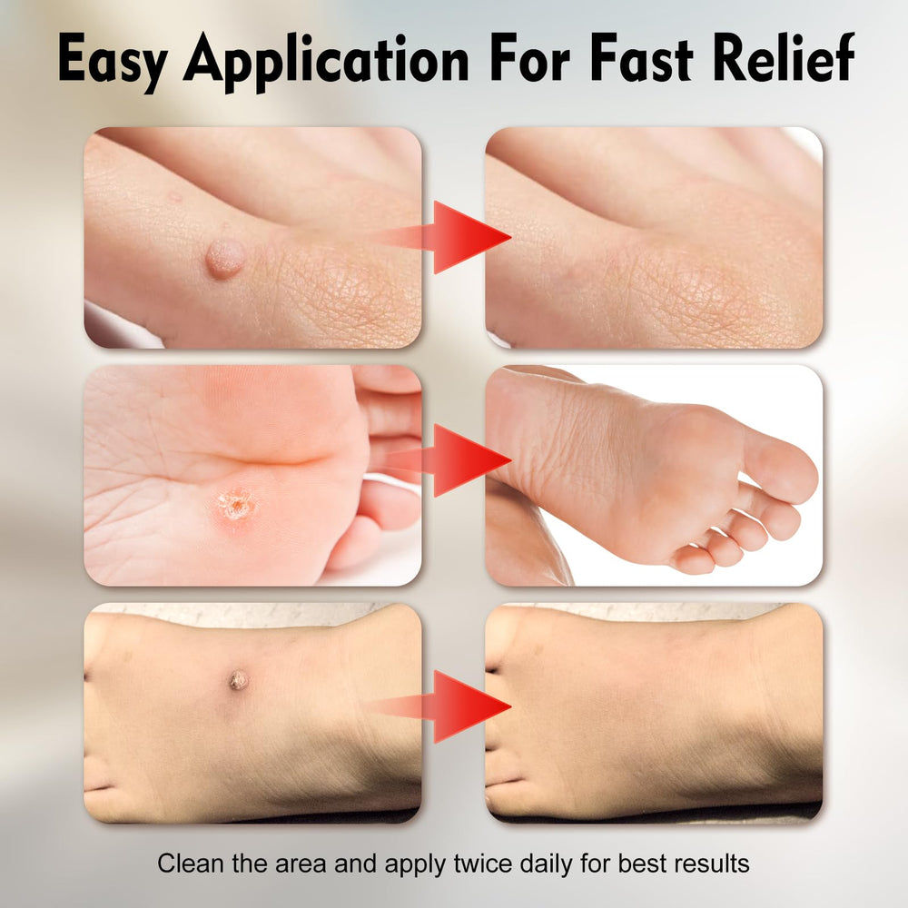 OJIOG visual of wart size reduction progress over time