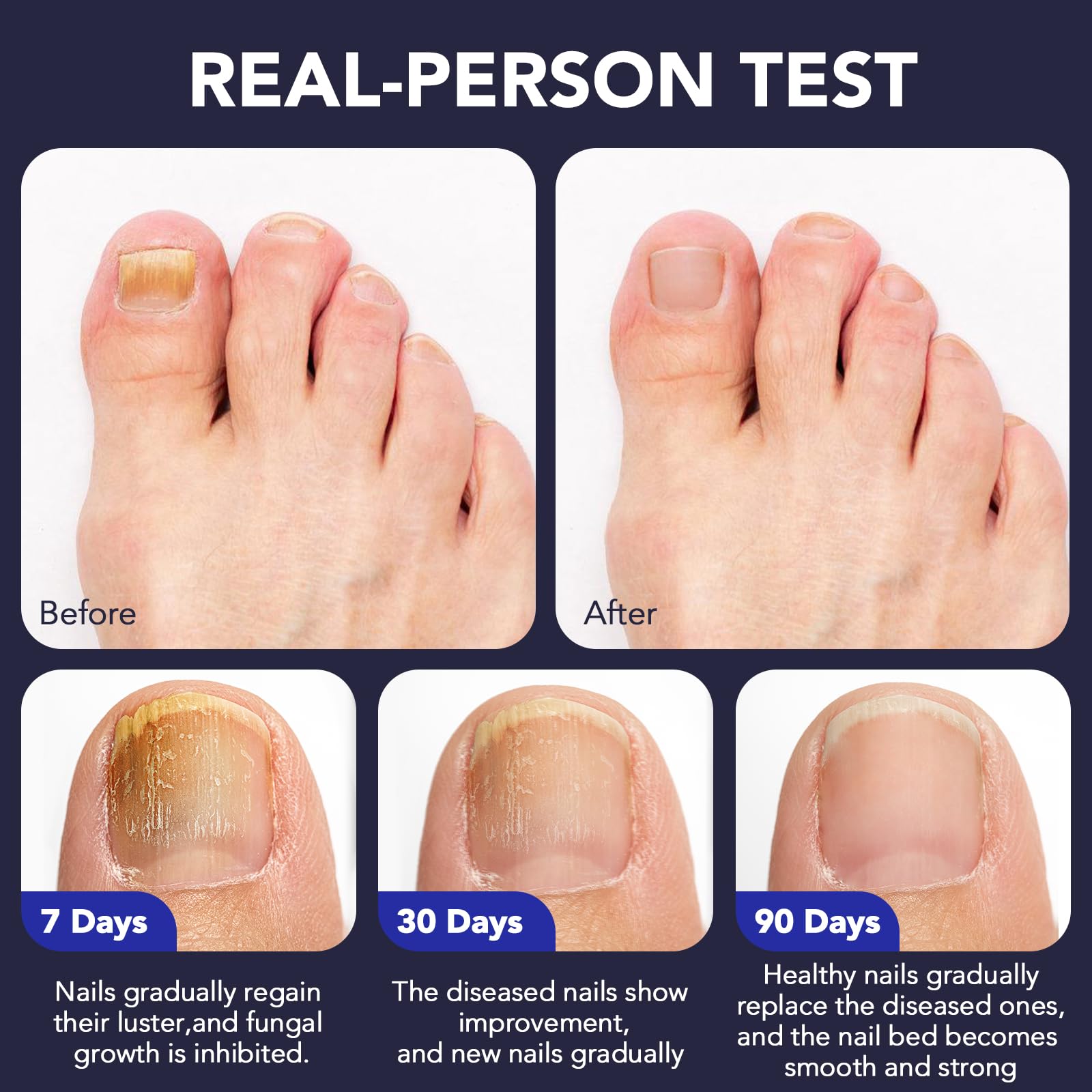 OMZOK Nail-repair action on damaged-nails demonstrates texture restoration over time.