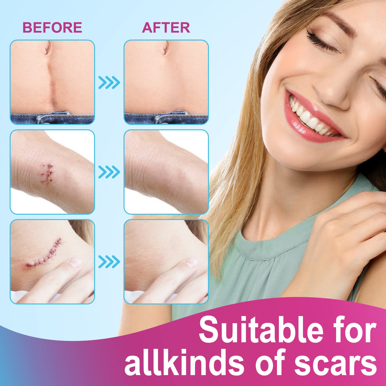 ONE1X silicone scar roll being applied to the hand for view