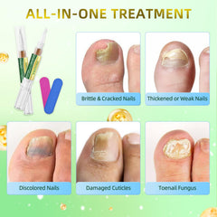 ONIADBA Toenail Fungus Pen enables precise under-nail coverage.