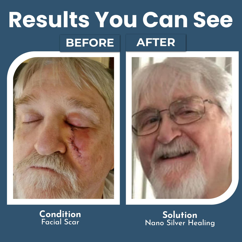 OPTIVIDA Colloidal Silver Gel on a minor wound for potential soothing care.