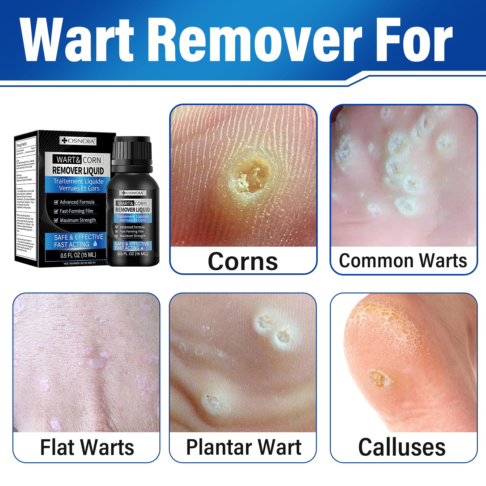 OSNOIA Wart Remover Liquid with breathable mask technology protects skin during healing.