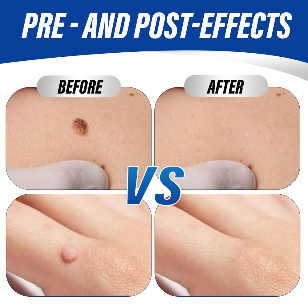 OSNOIA wart remover used for plantar wart treatment on foot