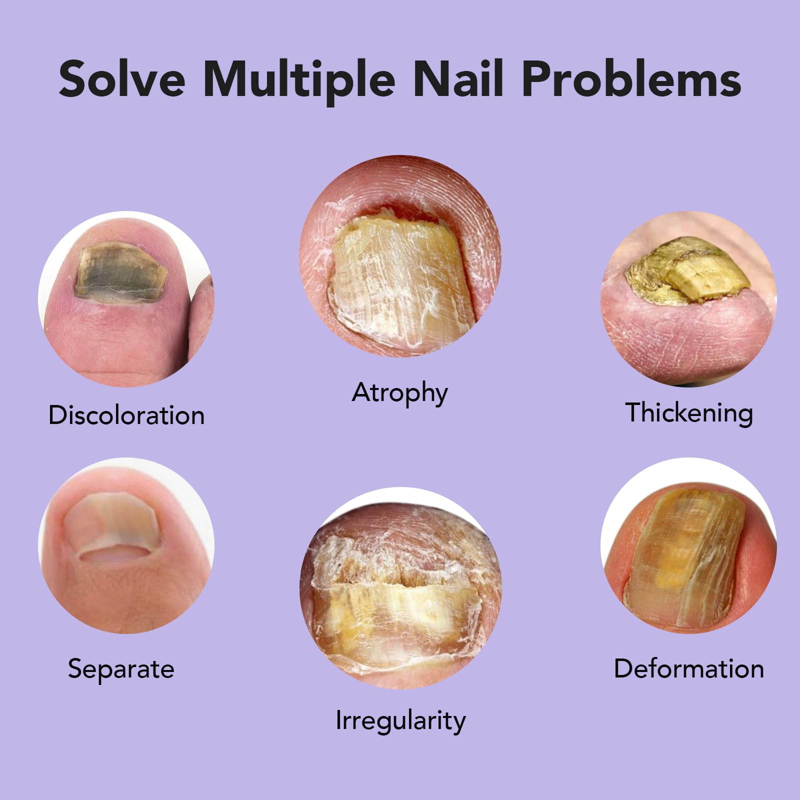 Ourui One ingrown toenail care targets nail edge discomfort.