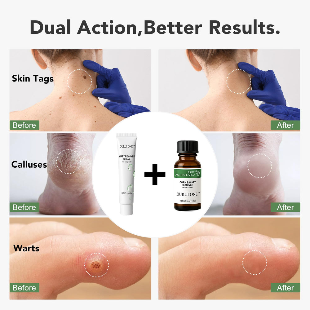 Ourui One Wart Remover ointment jar for larger or sensitive areas