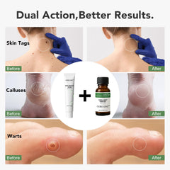 Ourui One Wart Remover ointment jar for larger or sensitive areas