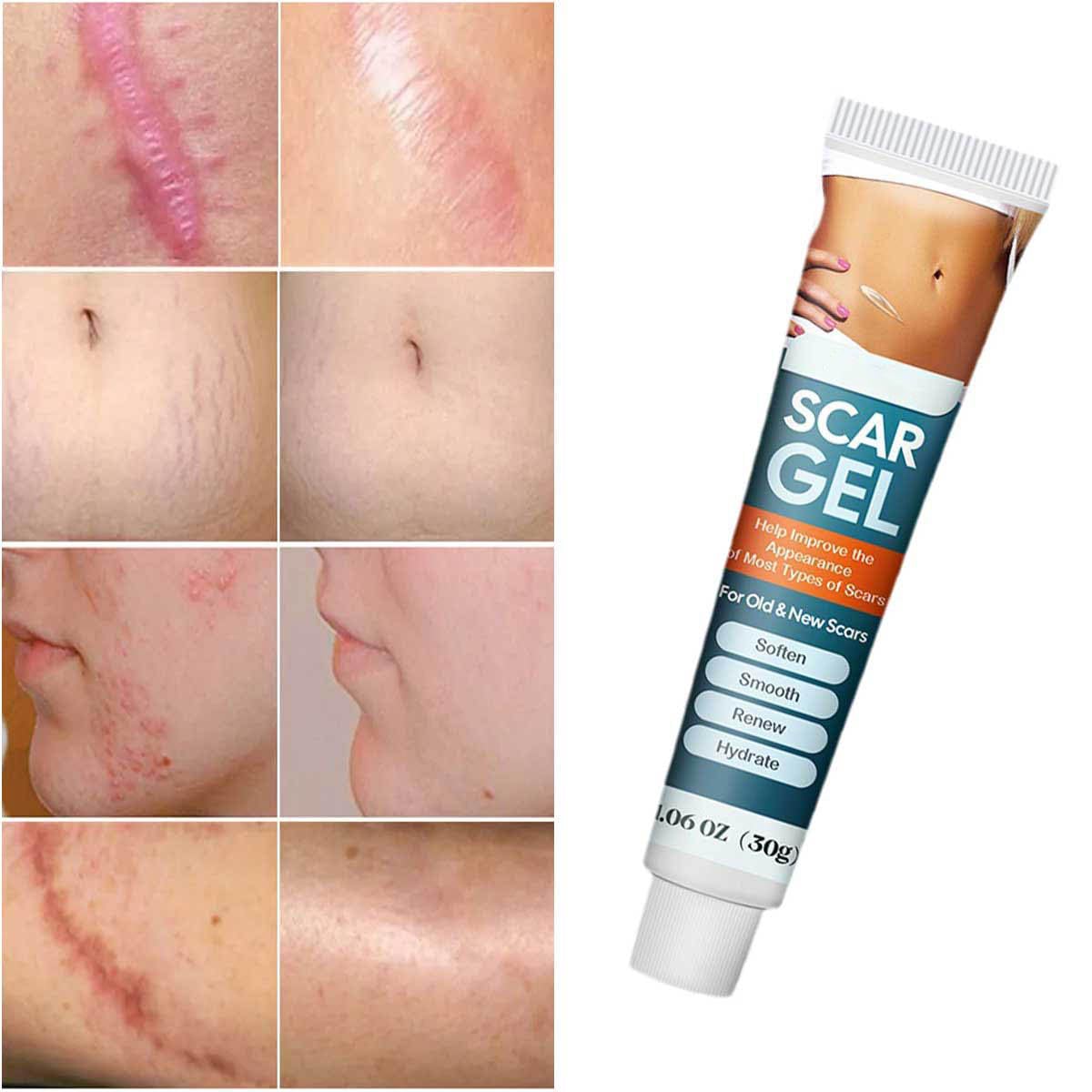 Pinnoocy scar gel bottle with pump for easy application
