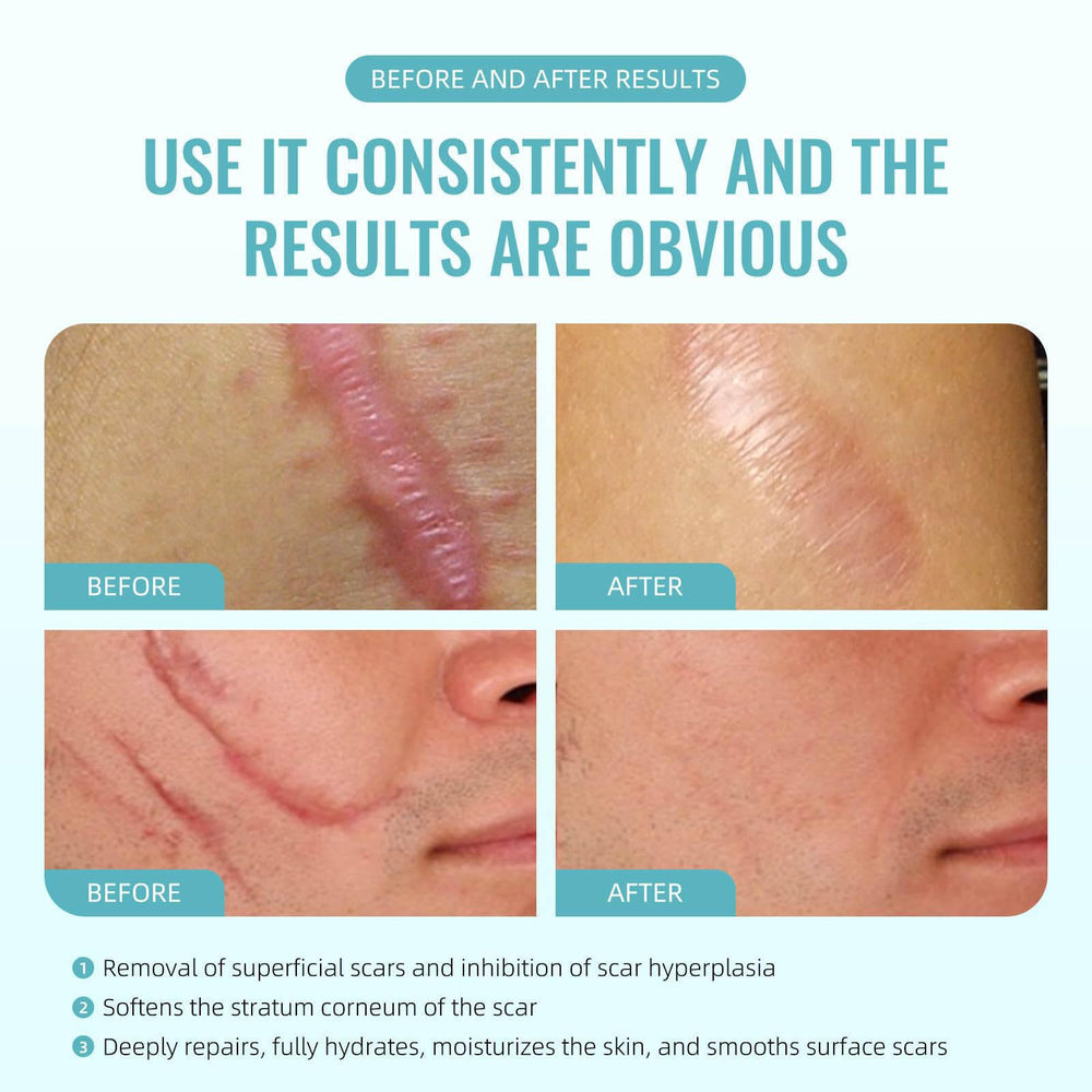 Pinnoocy scar gel packaging shown for travel use