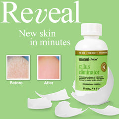 ProLinc Eliminador de Callos, gel suave para eliminar durezas en pies.