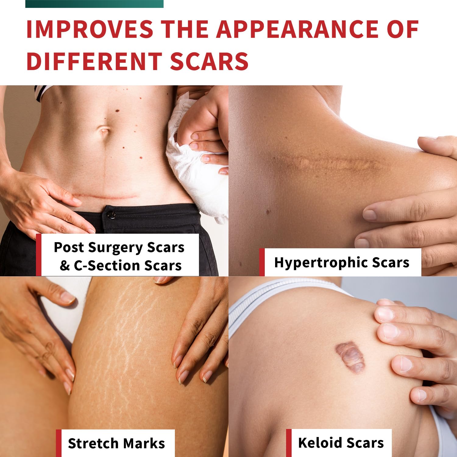 Latex-free Protect Life scar tape suitable for all ages