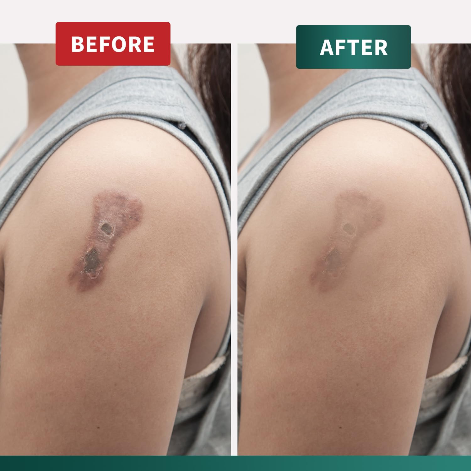 Protect Life silicone scar gel after surgery, for daily use