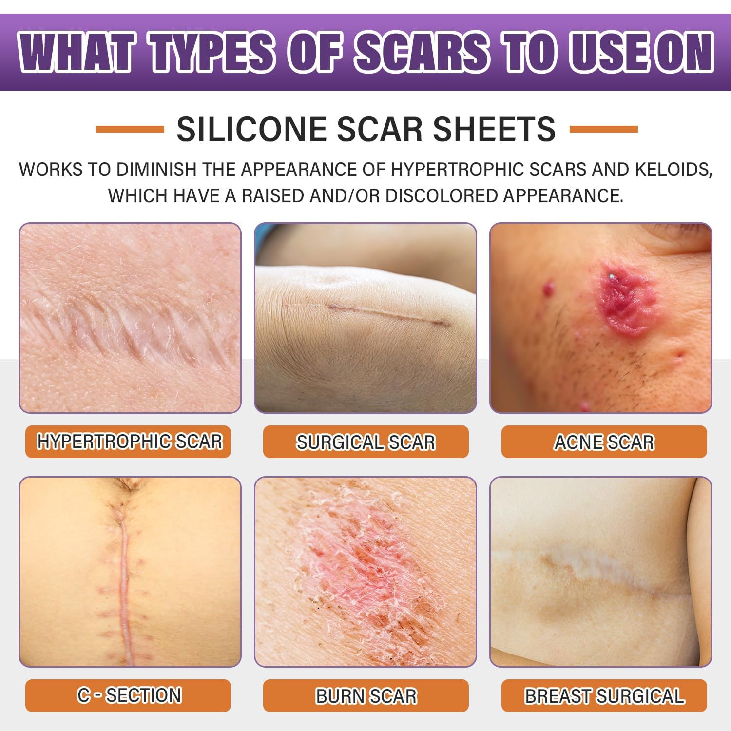 Psecici silicone scar tape roll supports discreet, flexible coverage for daily wear.
