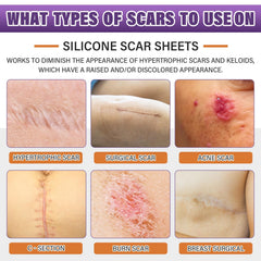 Psecici silicone scar tape roll supports discreet, flexible coverage for daily wear.