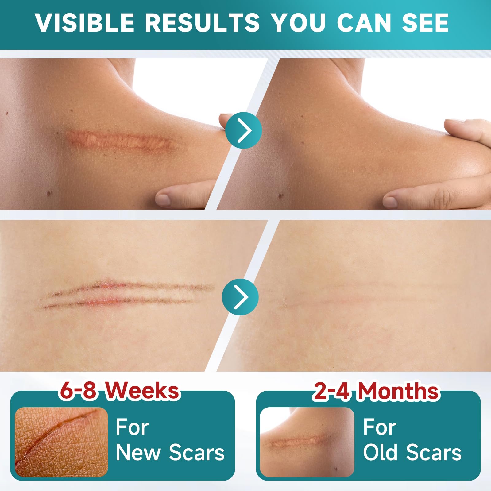 Pumkot silicone scar tape applied on skin demonstrates discreet coverage.