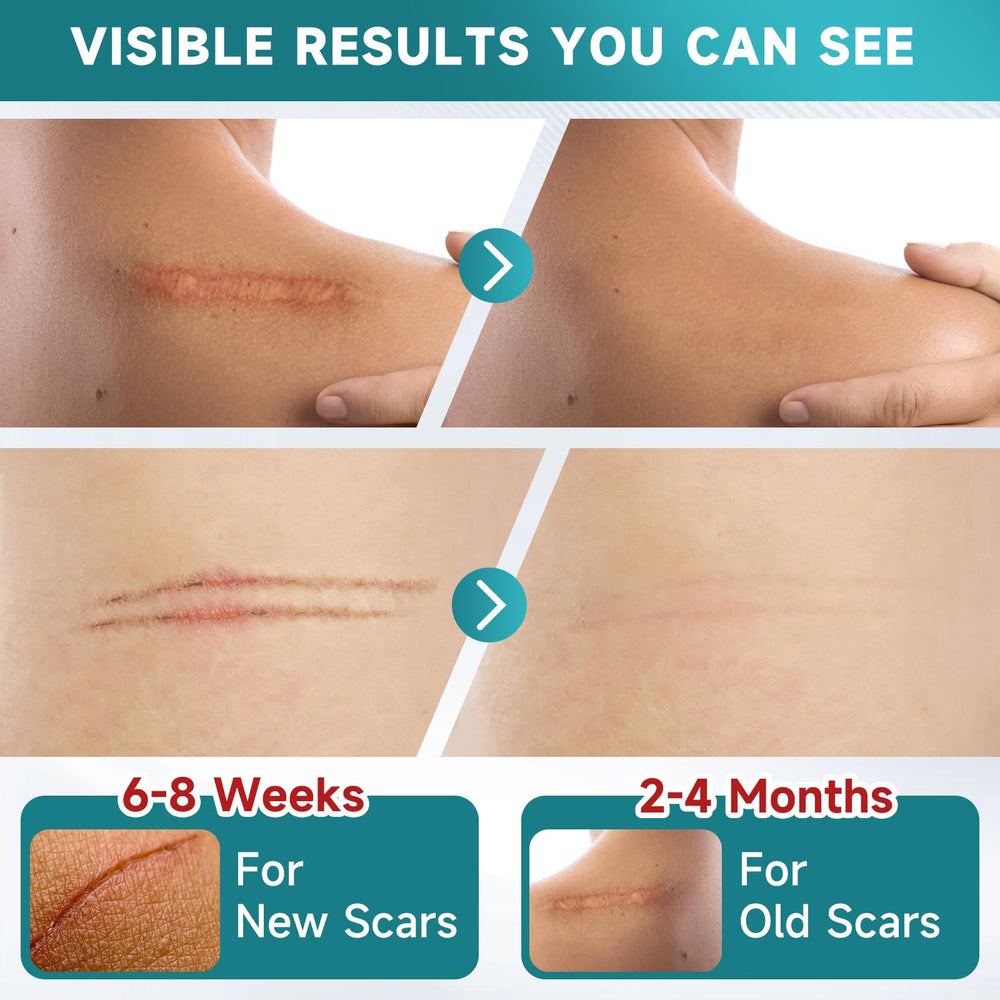 Pumkot silicone scar tape cutting-application, easy sizing for irregular scar shapes