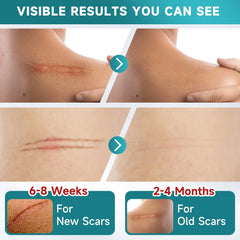 Pumkot silicone scar tape cutting-application, easy sizing for irregular scar shapes