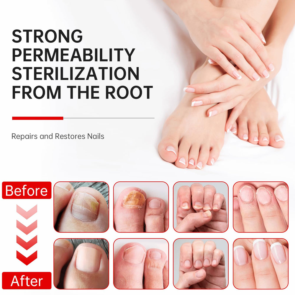 QQE Nail Fungus Treatment thin-layer application shown