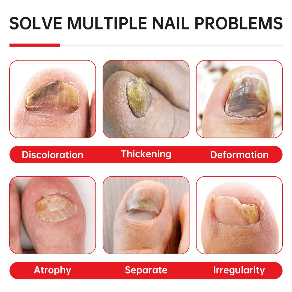 QQE Nail Fungus Treatment dropper enables precise application