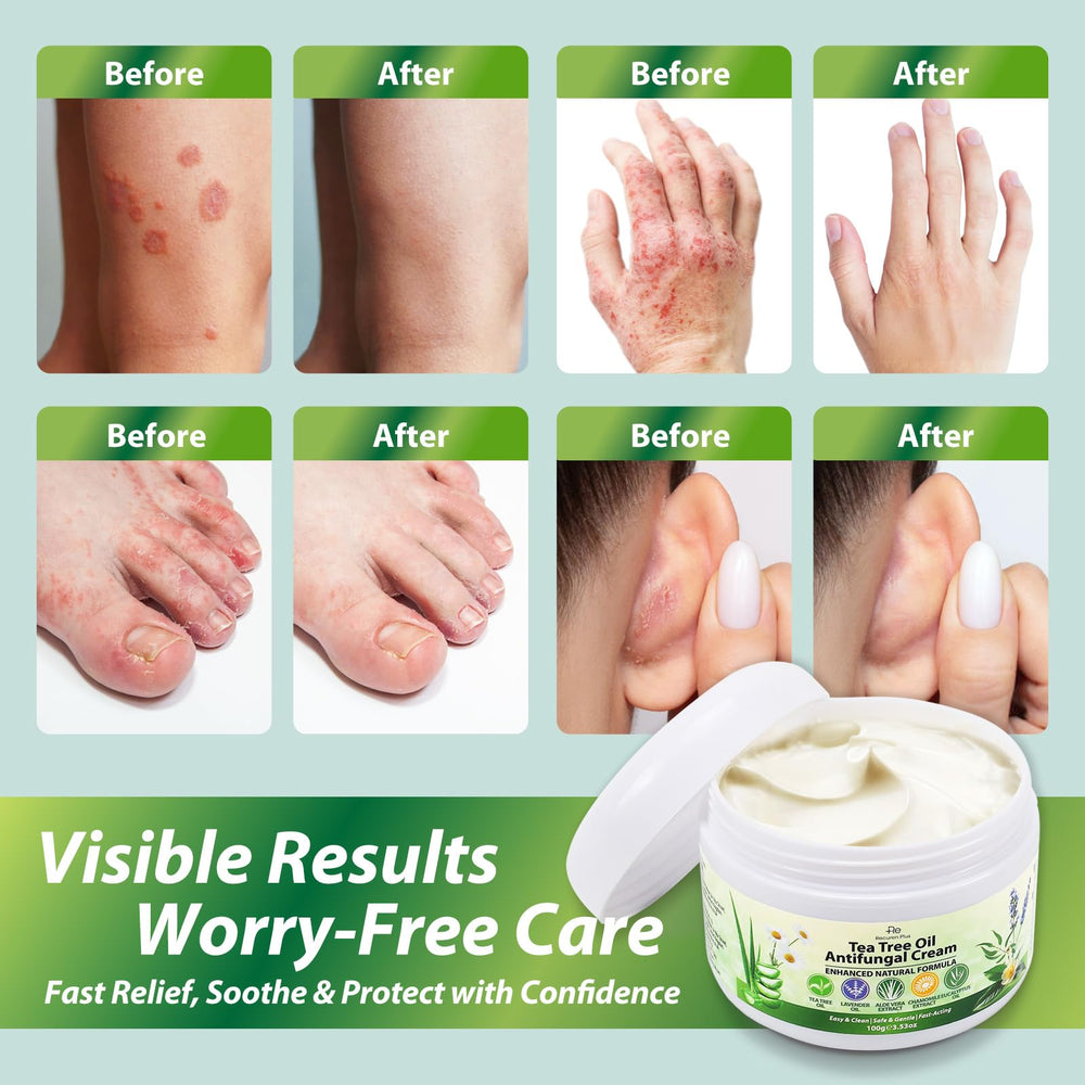 Recuren Plus skin barrier protection closeup illustrates gentle antifungal care.
