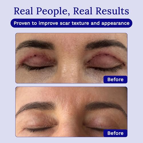 Facial scar treated with RejuvaSil silicone gel for even tone.