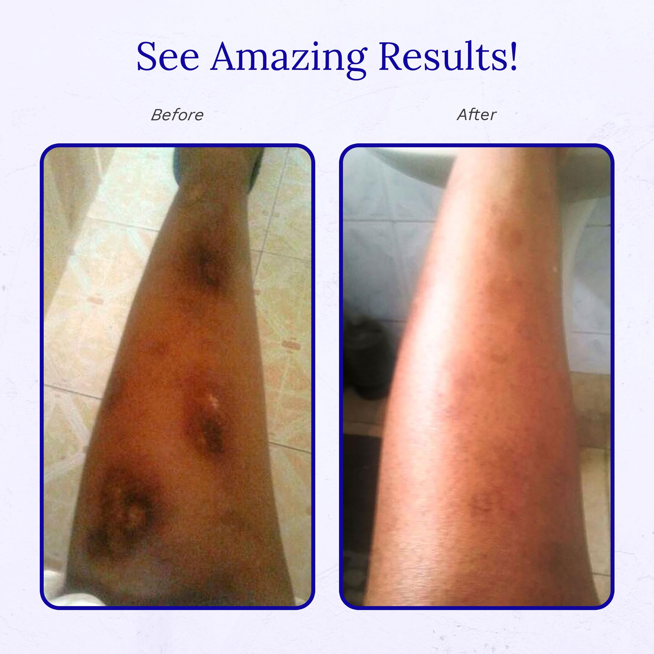 Rejuvaskin Scar Esthetique after-use skin shows smoother texture