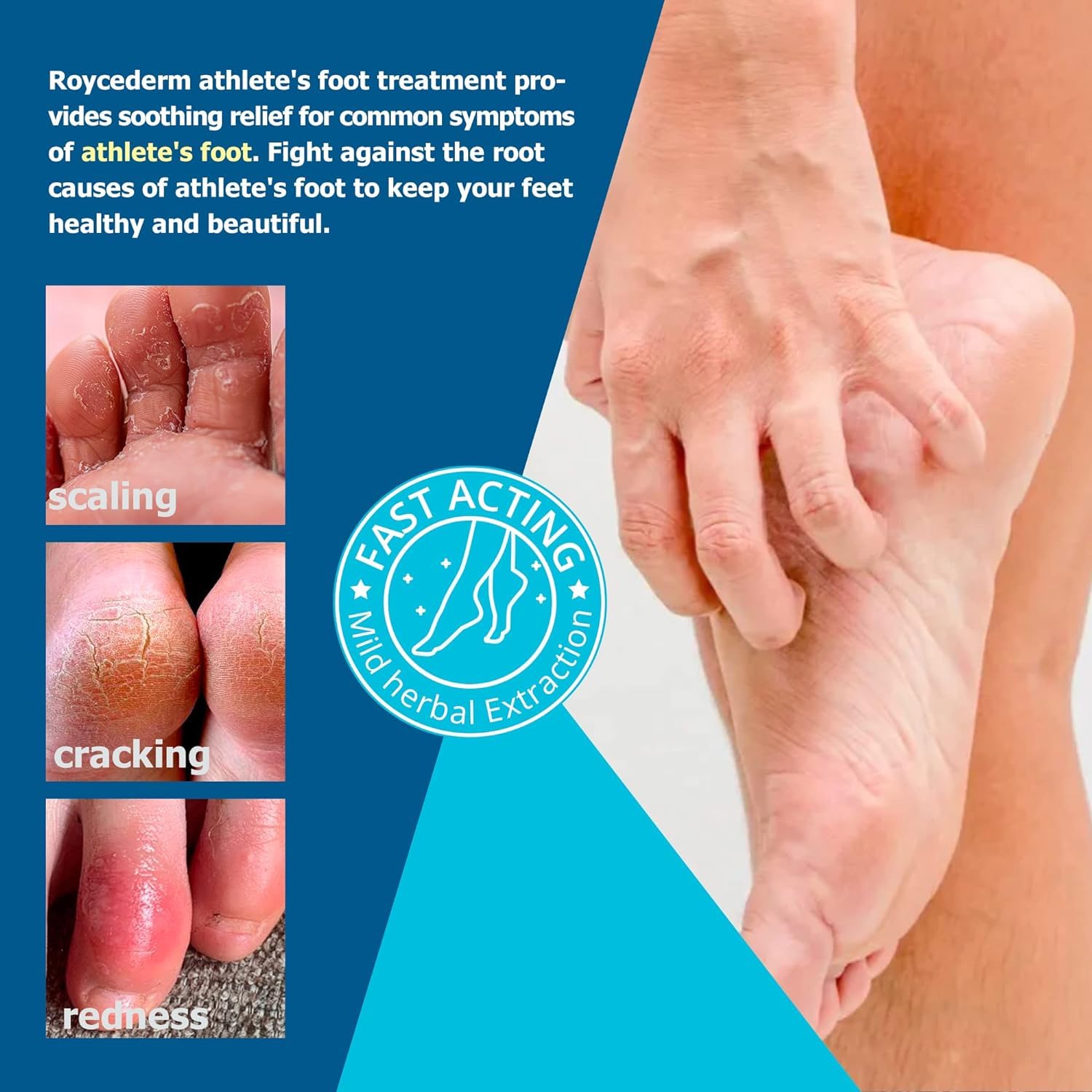 Roycederm Cream applied on foot closeup demonstrating soothing action.