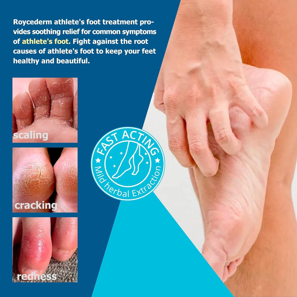 Roycederm Cream applied on foot closeup demonstrating soothing action.