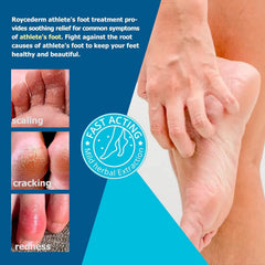 Roycederm Cream applied on foot closeup demonstrating soothing action.
