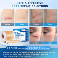Rvlaim silicone scar sheets keloid bump, smoothing potential around raised areas