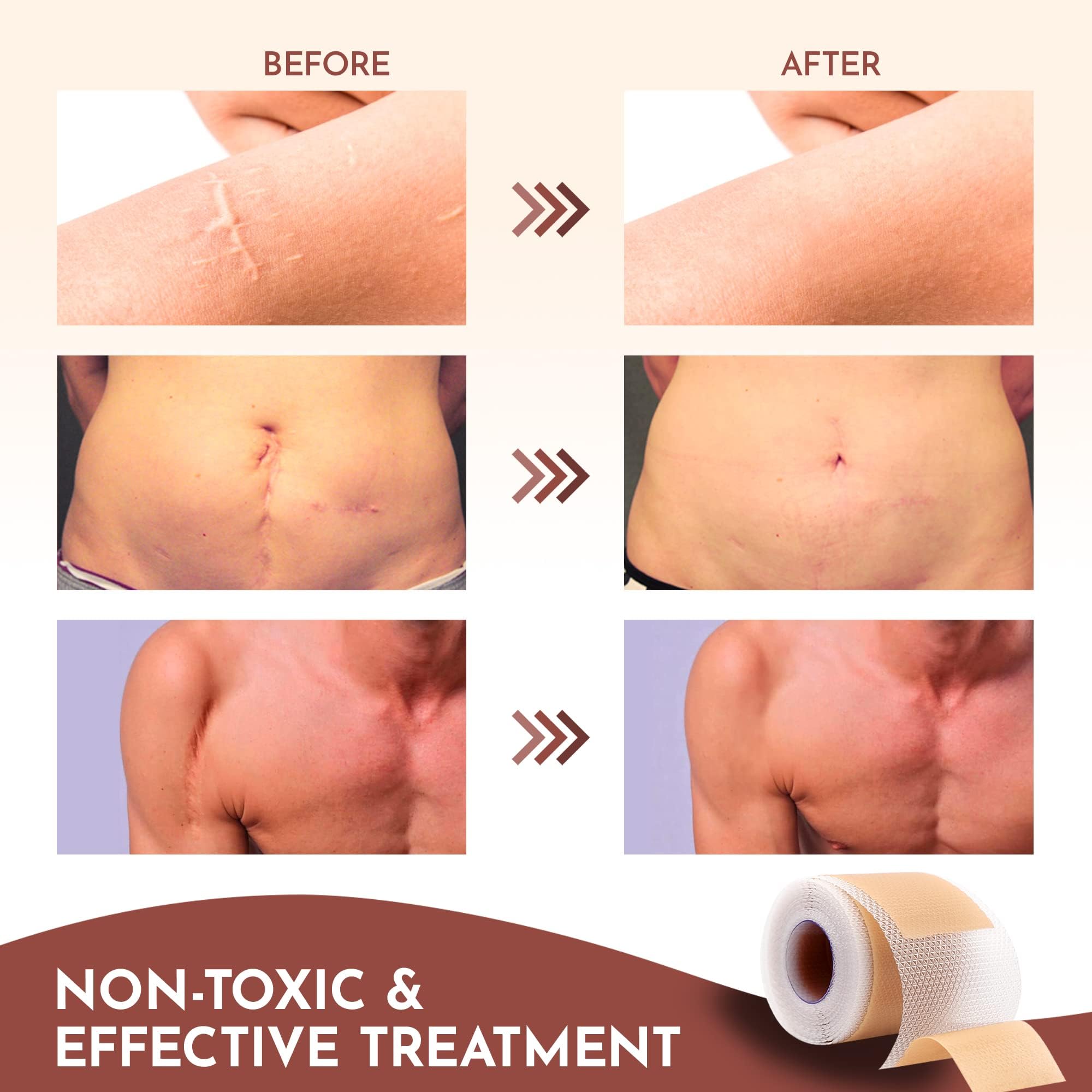 RWWXII silicone scar sheets adhere comfortably without irritation.