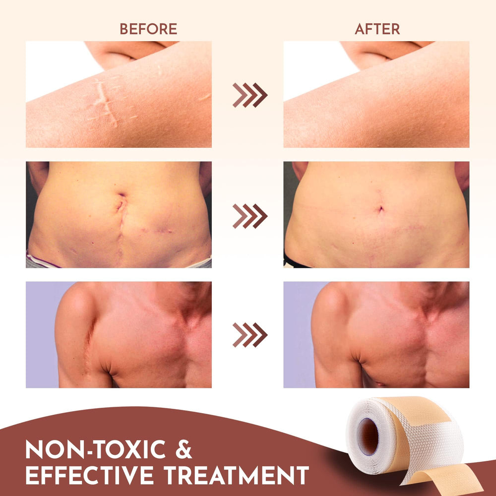 RWWXII silicone scar sheets adhere comfortably without irritation.