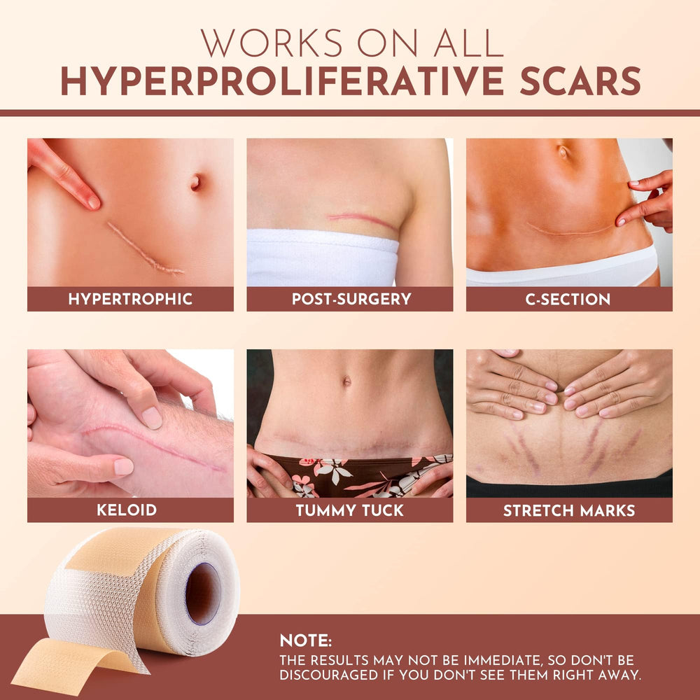 RWWXII silicone scar-tape pre-cut sizes provide easy, precise application.
