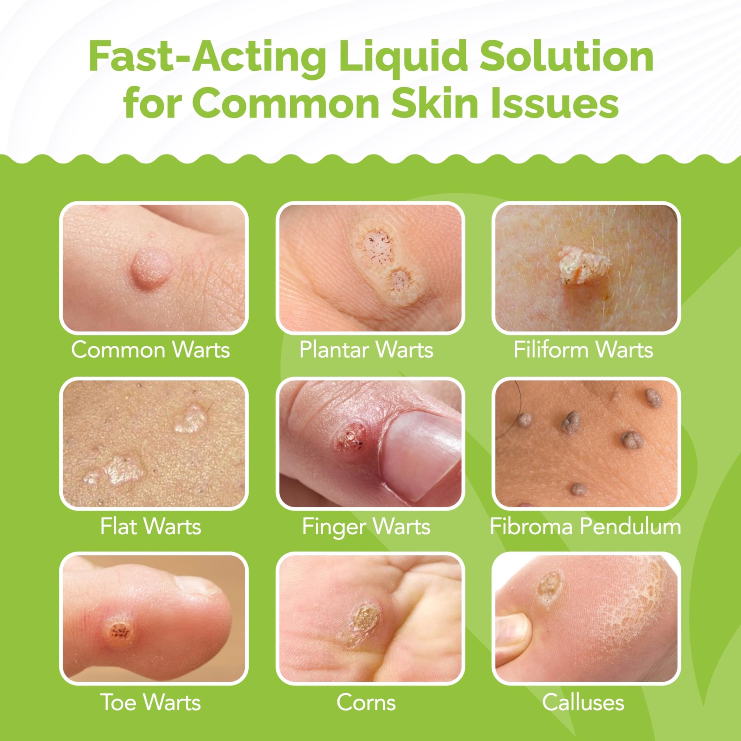 Samsali liquid wart remover applied drops on skin for targeted wart care.