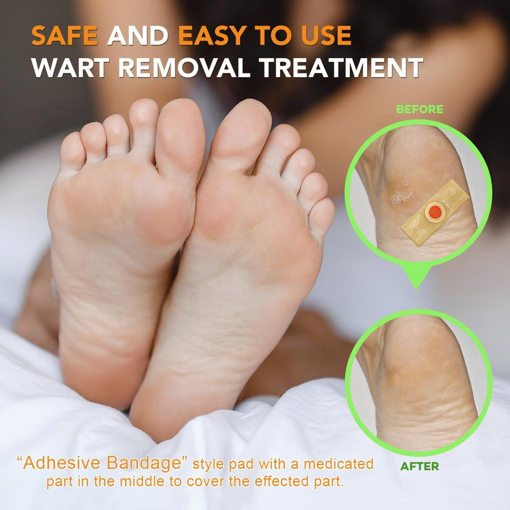 Samsali plantar wart pads designed for convenient home use