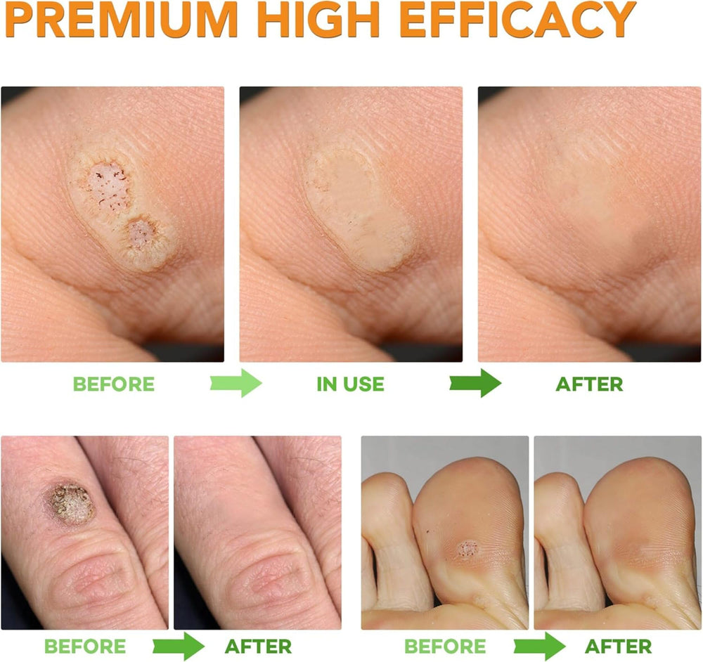 Samsali wart remover pads available in two sizes for versatile care